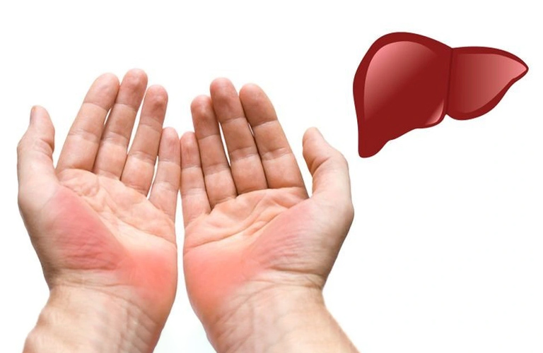 Một trong những triệu chứng điển hình của bệnh xơ gan là mu bàn tay nổi mẩn đỏ ngứa