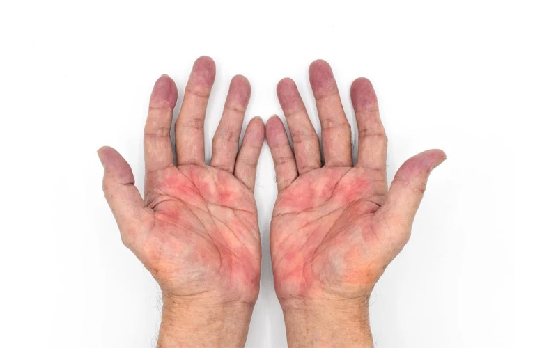 Mẩn đỏ và ngứa mu bàn tay thường không quá nguy hiểm