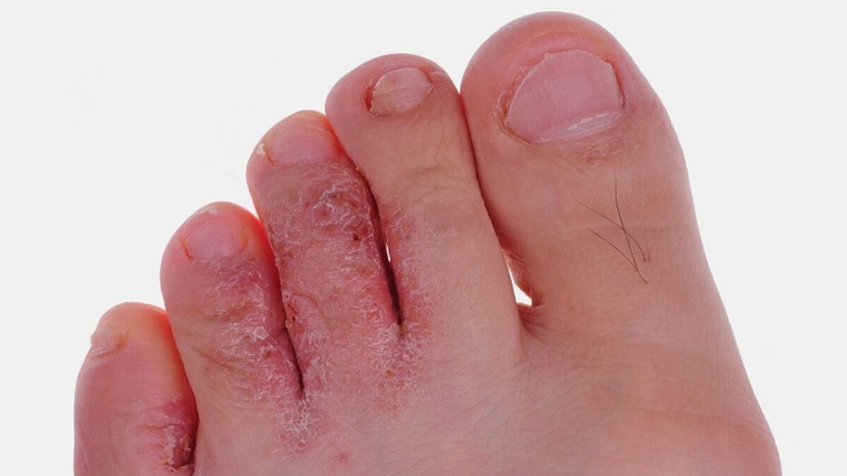 Ngứa các đầu ngón chân có thể là dấu hiệu của bệnh da liễu
