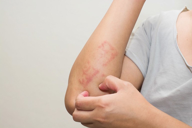 Ngứa da, viêm loét cũng có thể là dấu hiệu của bệnh viêm da tiếp xúc
