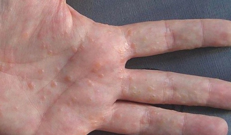 Ngứa tay nổi mụn nước gây khó chịu và làm ảnh hưởng tới sinh hoạt của người bệnh