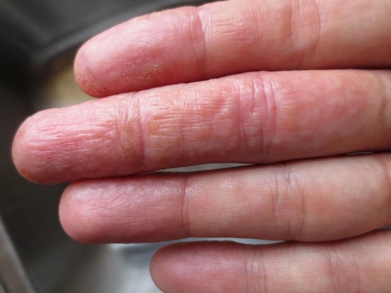 Bàn tay bị ngứa nổi mụn nước có thể là triệu chứng của bệnh viêm da